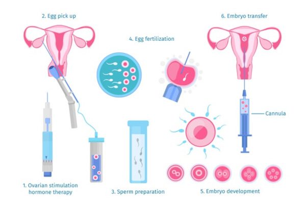 Εξωσωματική γονιμοποίηση IVF