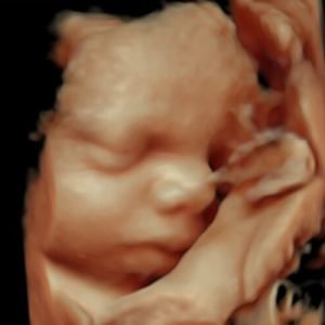 3D Υπερηχογράφημα