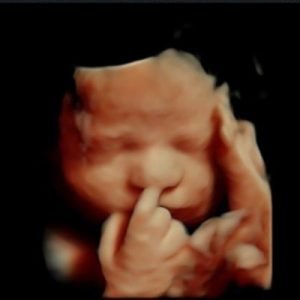 3D Υπερηχογράφημα