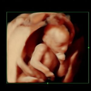 3D Υπερηχογράφημα