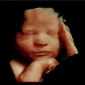 3D Υπερηχογράφημα