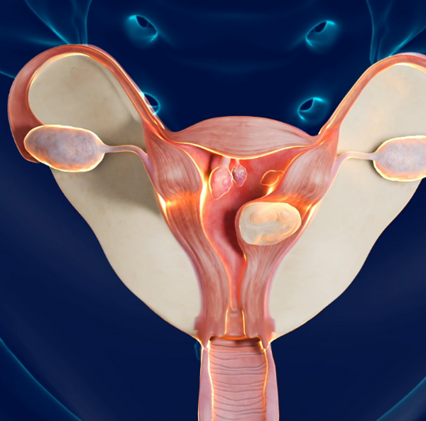 Ανάρρωση μετά από υστεροσκόπηση: Μία σημαντική διαγνωστική και θεραπευτική διαδικασία